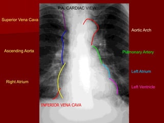 P.A. CARDIAC VIEW
Superior Vena Cava
Aortic Arch

Ascending Aorta

Pulmonary Artery

Left Atrium
Right Atrium
Left Ventricle

INFERIOR VENA CAVA

 