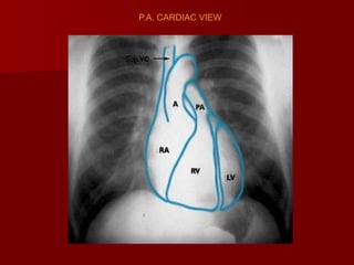 P.A. CARDIAC VIEW

 