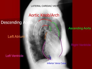 LATERAL CARDIAC VIEW

Aortic Knob/Arch
Descending Aorta
Ascending Aorta

Left Atrium
Right Ventricle

Left Ventricle
Inferior Vena Cava

 
