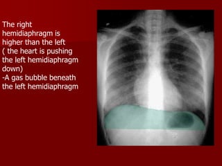 The right
hemidiaphragm is
higher than the left
( the heart is pushing
the left hemidiaphragm
down)
-A gas bubble beneath
the left hemidiaphragm

 