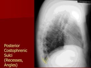 Posterior
Costophrenic
Sulci
(Recesses,
Angles)

 
