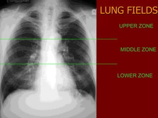 LUNG FIELDS
UPPER ZONE

MIDDLE ZONE

LOWER ZONE

 