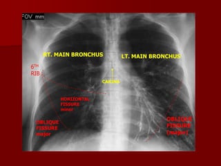 RT. MAIN BRONCHUS

LT. MAIN BRONCHUS

6TH
RIB
CARINA

HORIZONTAL
FISSURE
minor

OBLIQUE
FISSURE
major

OBLIQUE
FISSURE
(major)

 