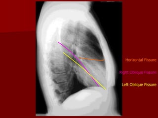 Horizontal Fissure
Right Oblique Fissure
Left Oblique Fissure

 