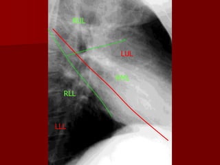 RUL

LUL
RML

RLL

LLL

 