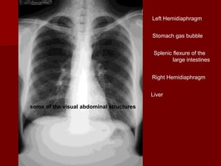 Left Hemidiaphragm
Stomach gas bubble
Splenic flexure of the
large intestines
Right Hemidiaphragm
Liver
some of the visual abdominal structures

 