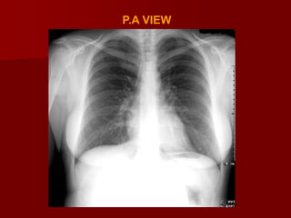 Normal Radiographic Anatomy
WITH
VIEWING CHEST RADIOGRAPH

 