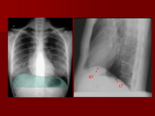 Significance of different views
Anteroposterior view


It is useful in differentiating free and loculated
pleural fluid

...