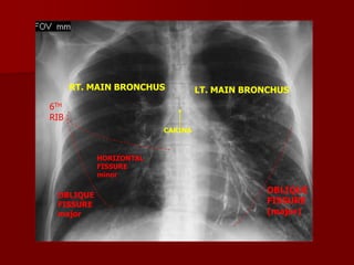 Chest x ray