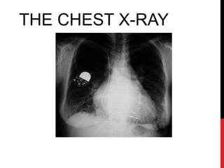THE CHEST X-RAY
 
