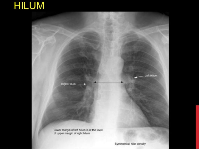 Chest x ray