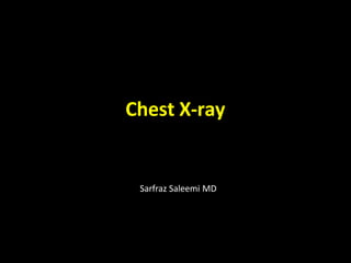 Chest X-ray
Sarfraz Saleemi MD
 