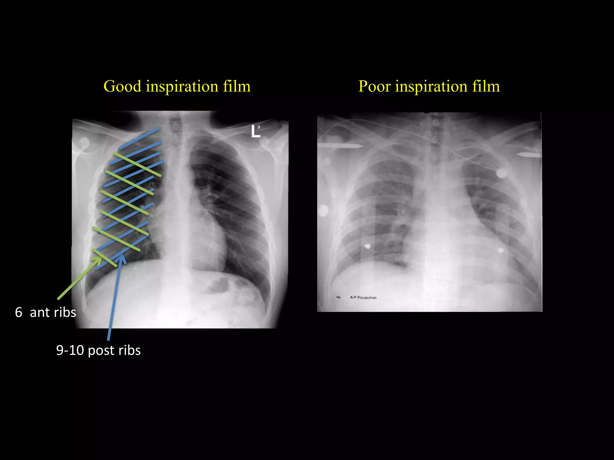 Chest X-ray Interpretation | PDF