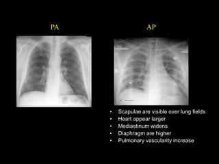 Chest X-ray Interpretation | PPT
