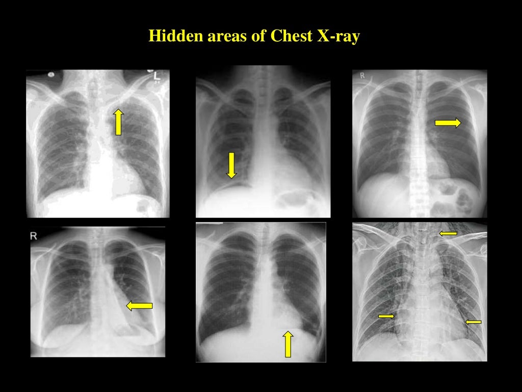 Chest Xray Interpretation