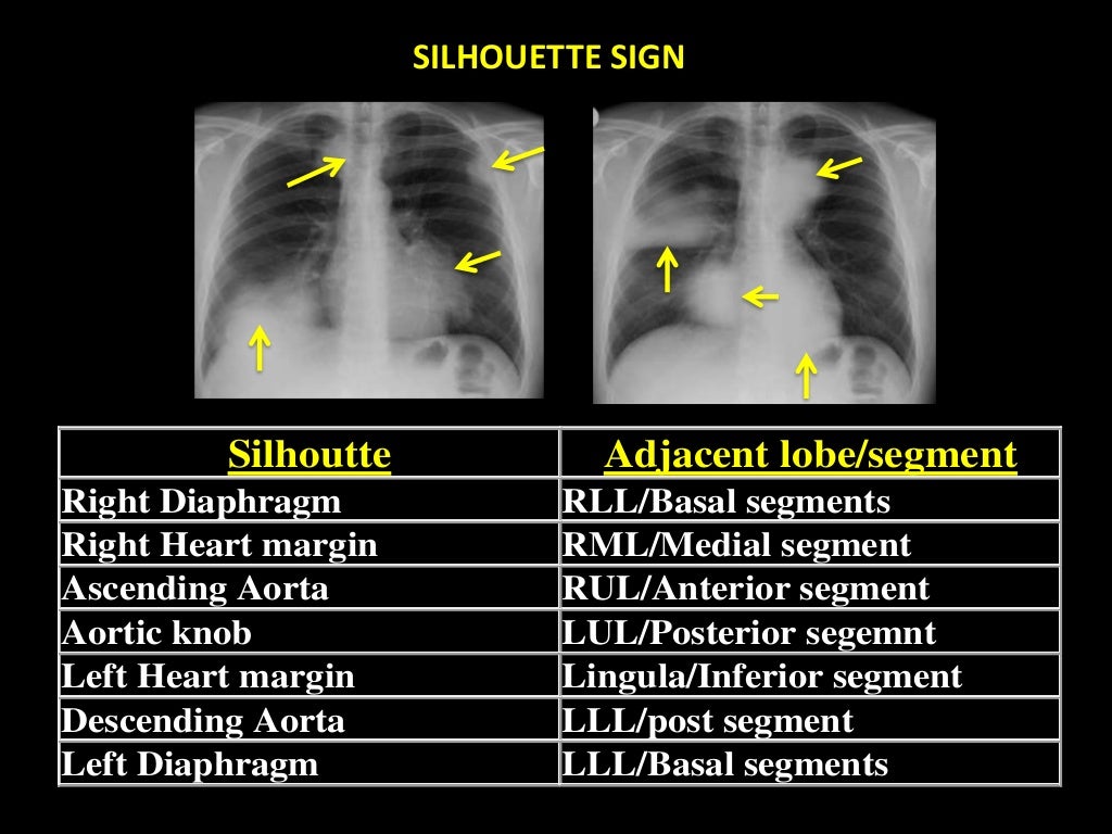 Chest Xray Interpretation
