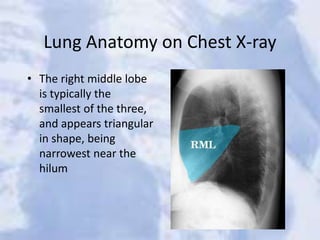 Lung Anatomy on Chest X-ray
• The right middle lobe
is typically the
smallest of the three,
and appears triangular
in shape, being
narrowest near the
hilum
 