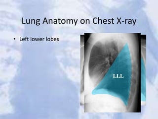 Lung Anatomy on Chest X-ray
• Left lower lobes
 