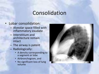 Consolidation
• Lobar consolidation:
– Alveolar space filled with
inflammatory exudate
– Interstitium and
architecture remain
intact
– The airway is patent
– Radiologically:
• A density corresponding to
a segment or lobe
• Airbronchogram, and
• No significant loss of lung
volume
 