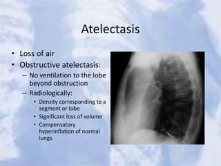 Atelectasis
• Loss of air
• Obstructive atelectasis:
– No ventilation to the lobe
beyond obstruction
– Radiologically:
• Density corresponding to a
segment or lobe
• Significant loss of volume
• Compensatory
hyperinflation of normal
lungs
 