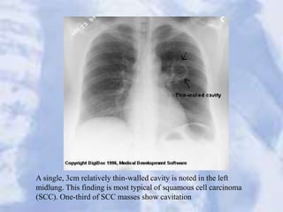 A single, 3cm relatively thin-walled cavity is noted in the left
midlung. This finding is most typical of squamous cell carcinoma
(SCC). One-third of SCC masses show cavitation
 