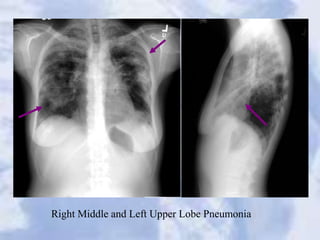 Right Middle and Left Upper Lobe Pneumonia
 