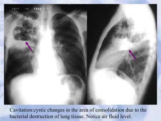 Cavitation:cystic changes in the area of consolidation due to the
bacterial destruction of lung tissue. Notice air fluid level.
 