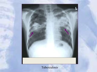 Tuberculosis
 