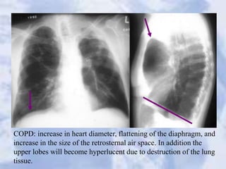 COPD: increase in heart diameter, flattening of the diaphragm, and
increase in the size of the retrosternal air space. In addition the
upper lobes will become hyperlucent due to destruction of the lung
tissue.
 