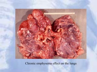 Chronic emphysema effect on the lungs
 