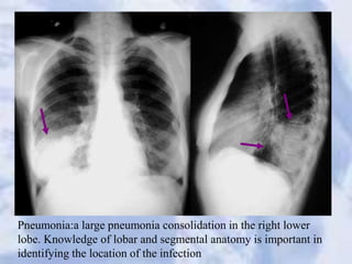 Pneumonia:a large pneumonia consolidation in the right lower
lobe. Knowledge of lobar and segmental anatomy is important in
identifying the location of the infection
 