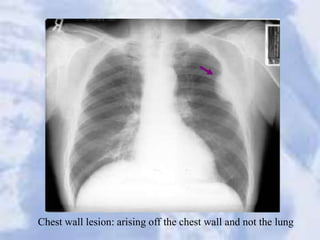 Chest wall lesion: arising off the chest wall and not the lung
 