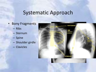 Systematic Approach
• Bony Fragments
– Ribs
– Sternum
– Spine
– Shoulder girdle
– Clavicles
 