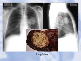 Lung Mass
 