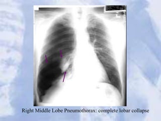 Right Middle Lobe Pneumothorax: complete lobar collapse
 