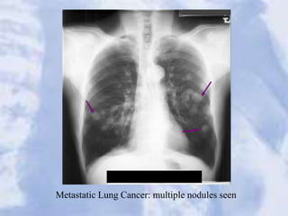Metastatic Lung Cancer: multiple nodules seen
 