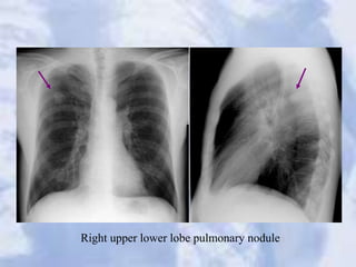 Right upper lower lobe pulmonary nodule
 