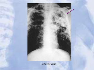 Tuberculosis
 