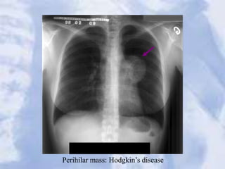 Perihilar mass: Hodgkin’s disease
 
