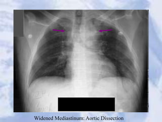 Widened Mediastinum: Aortic Dissection
 