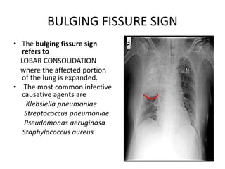 CHEST X-RAY.PPT.pptx