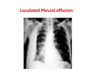 Understanding and Reading of Chest X-Rays | PPTX