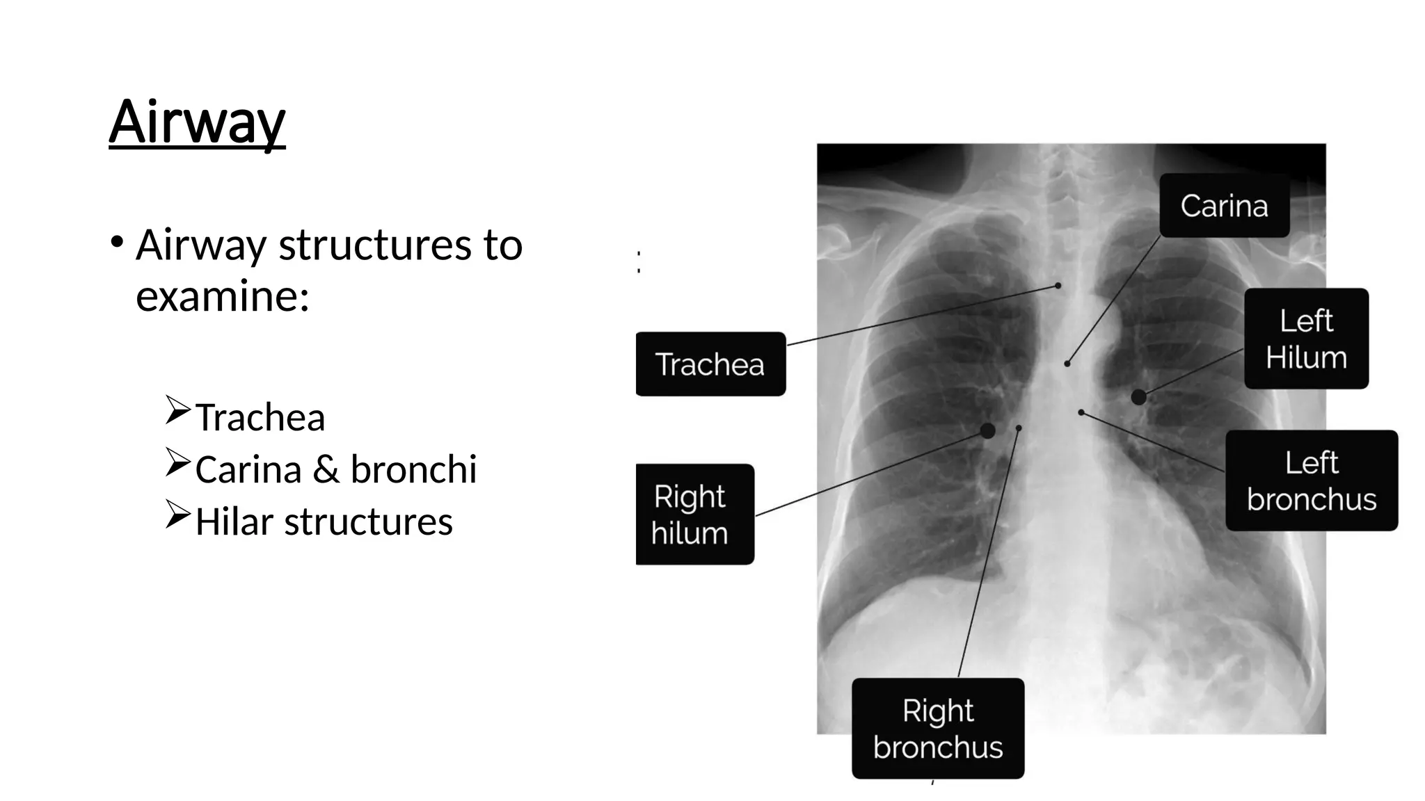Airway
• Airway structures to
examine:
Trachea
Carina & bronchi
Hilar structures
 