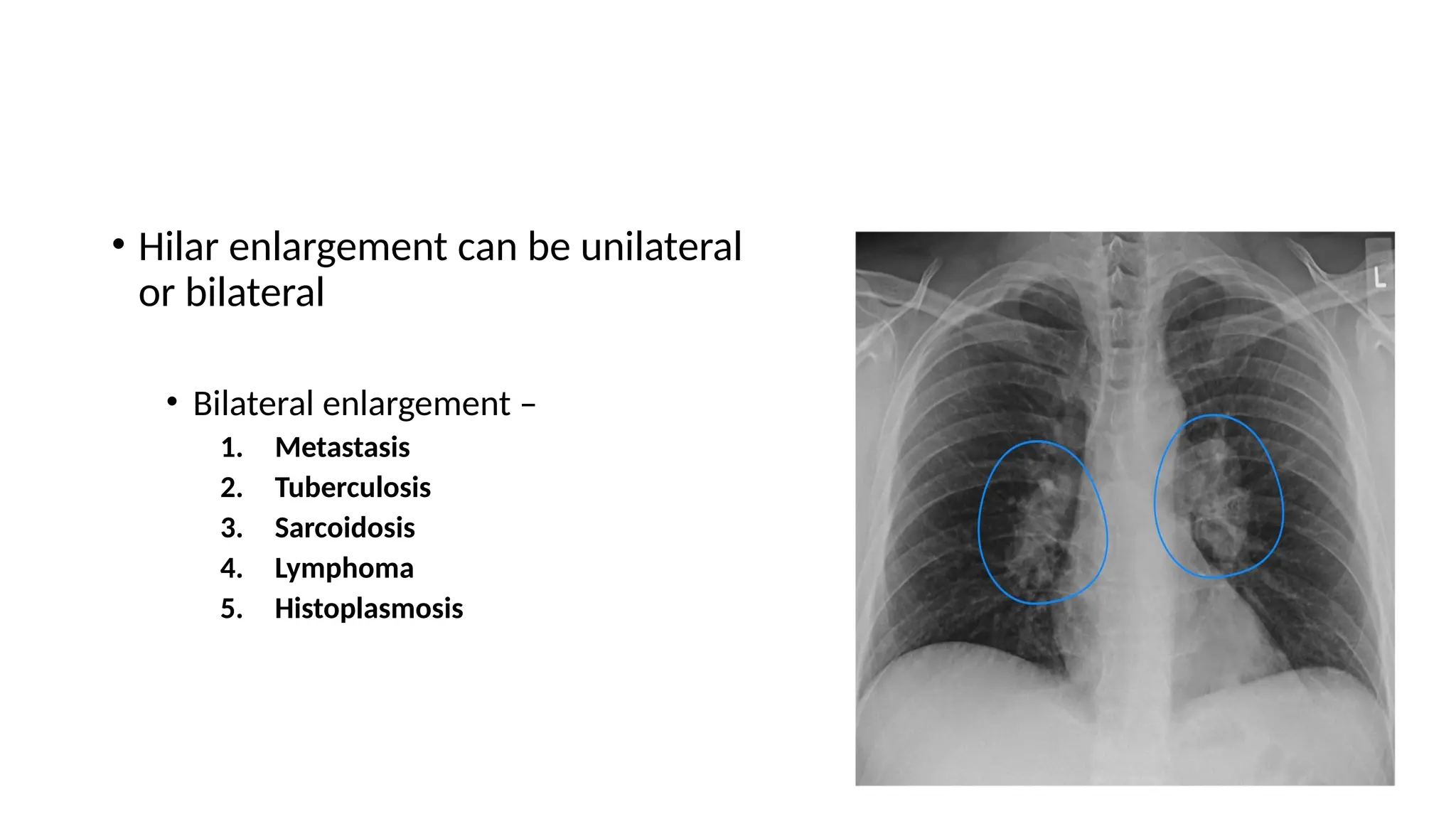 • Hilar enlargement can be unilateral
or bilateral
• Bilateral enlargement –
1. Metastasis
2. Tuberculosis
3. Sarcoidosis
4. Lymphoma
5. Histoplasmosis
 