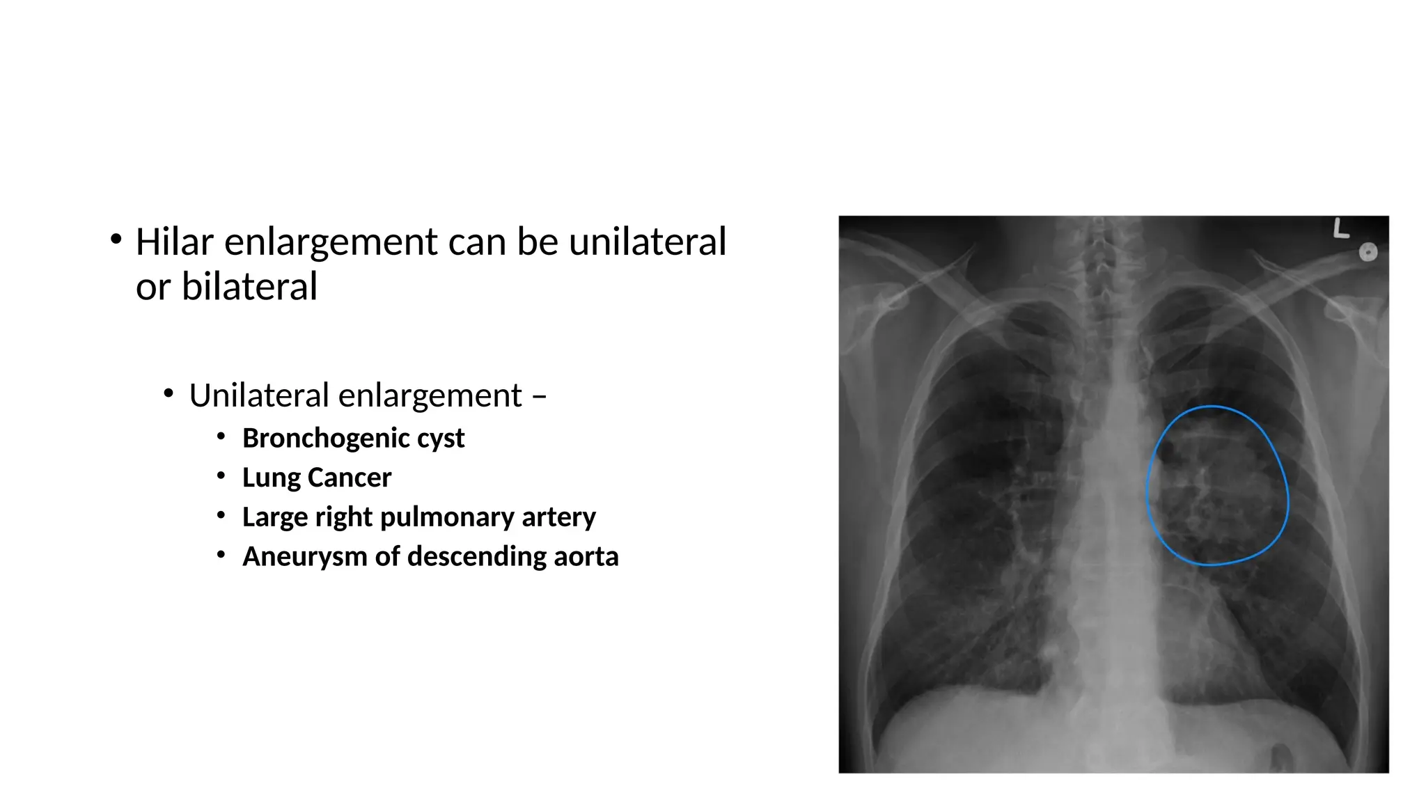 • Hilar enlargement can be unilateral
or bilateral
• Unilateral enlargement –
• Bronchogenic cyst
• Lung Cancer
• Large right pulmonary artery
• Aneurysm of descending aorta
 