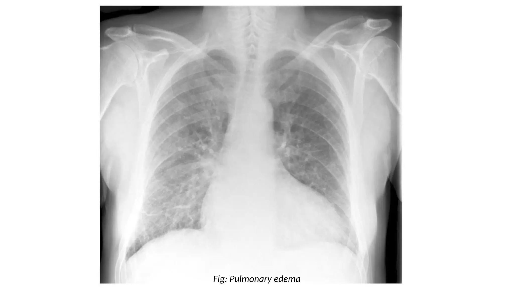 Fig: Pulmonary edema
 