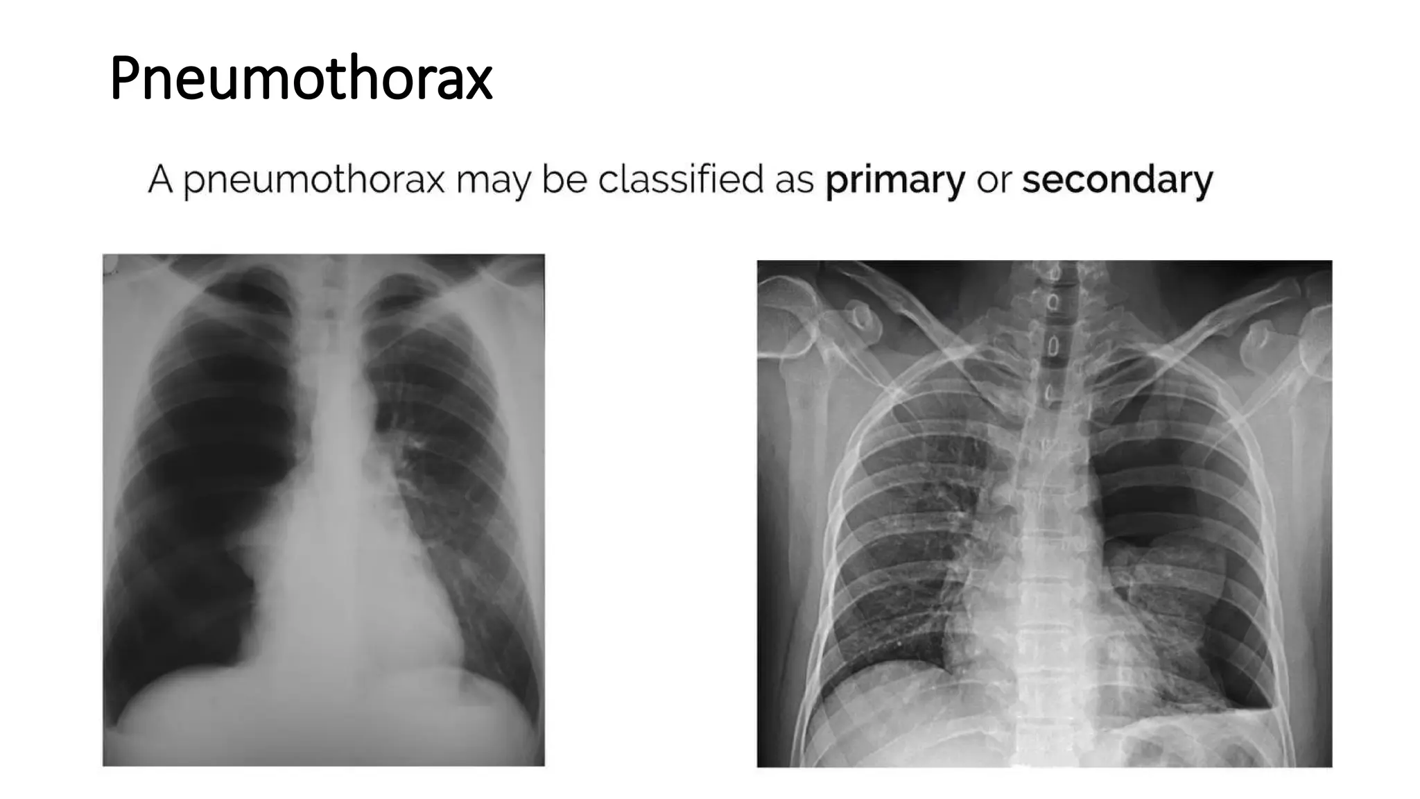 Pneumothorax
 