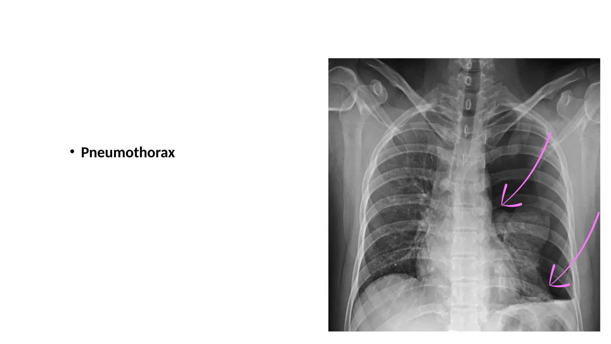 • Pneumothorax
 