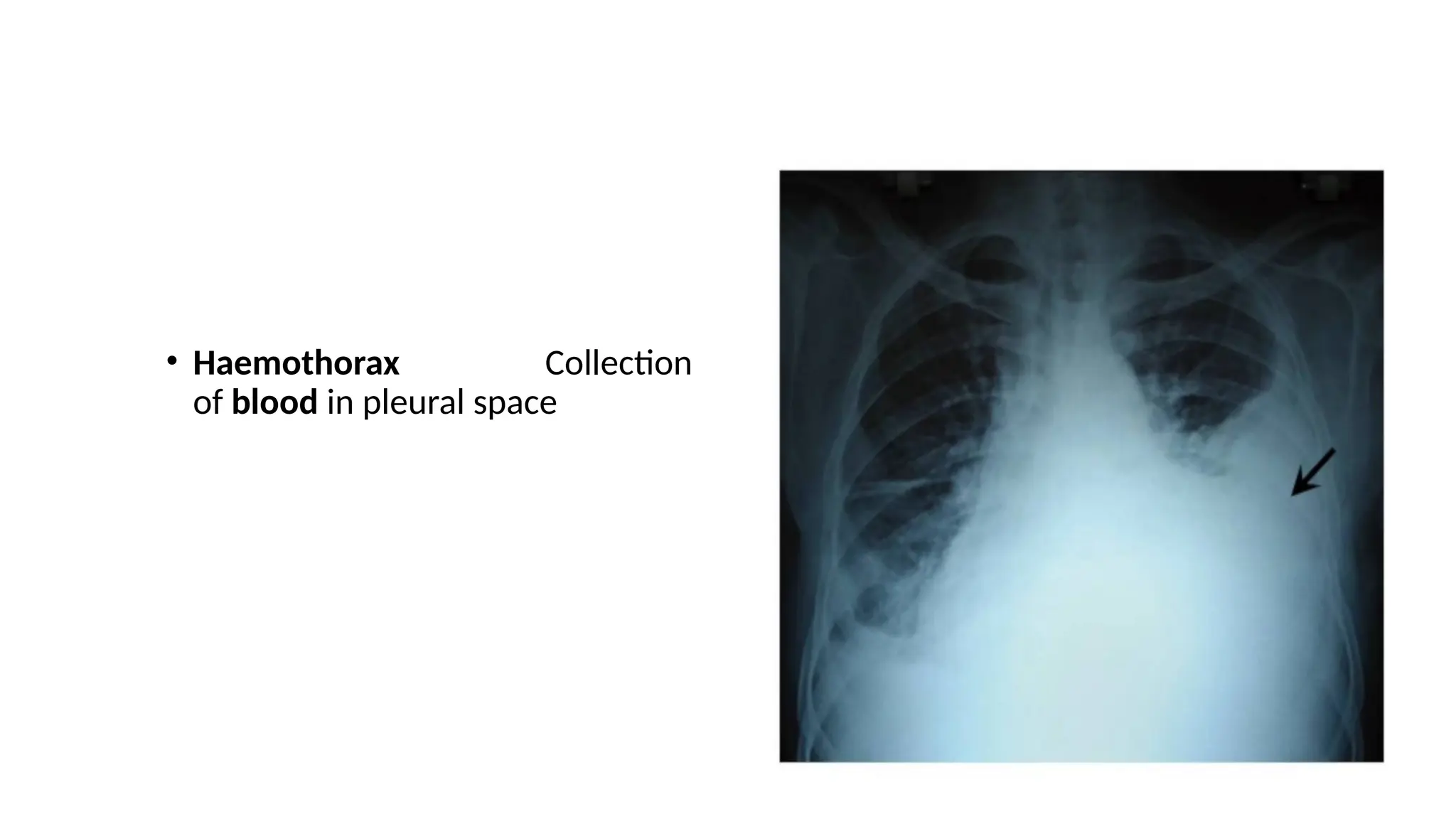 • Haemothorax Collection
of blood in pleural space
 