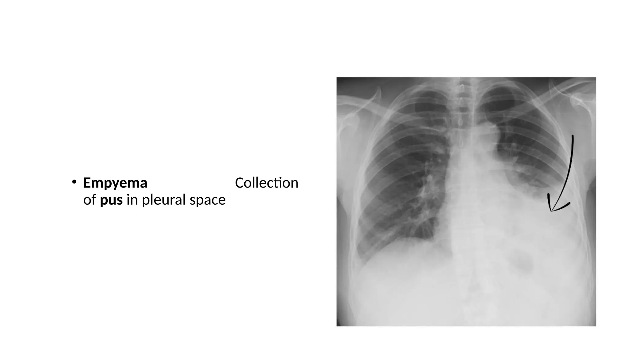 • Empyema Collection
of pus in pleural space
 